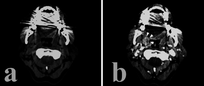 Imaging of human papilloma virus (HPV) related oropharynx tumour: what we know to date.