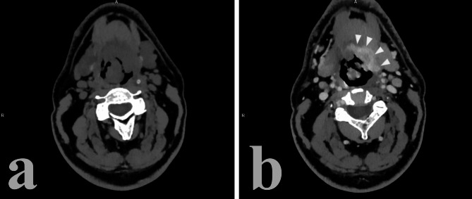 Imaging of human papilloma virus (HPV) related oropharynx tumour: what we know to date.