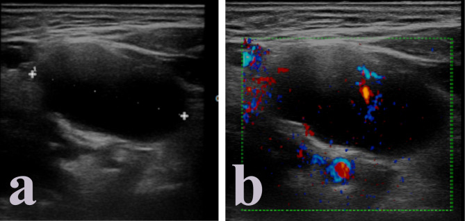 Imaging of human papilloma virus (HPV) related oropharynx tumour: what we know to date.