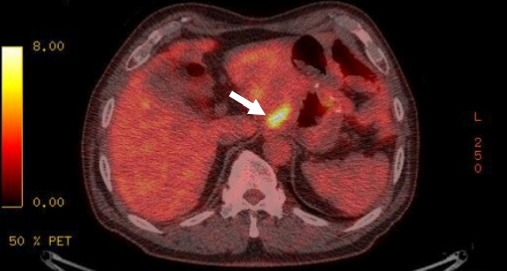 Intraabdominal abscess mimicking gastric cancer recurrence: a case report.