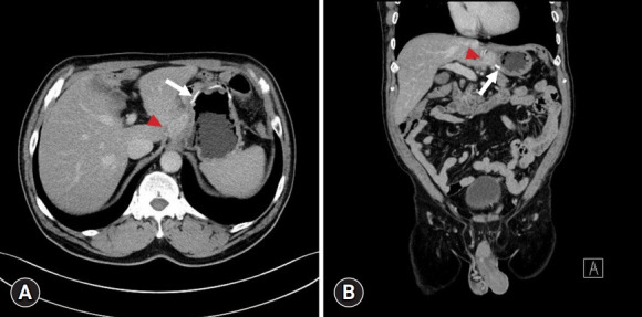 Intraabdominal abscess mimicking gastric cancer recurrence: a case report.