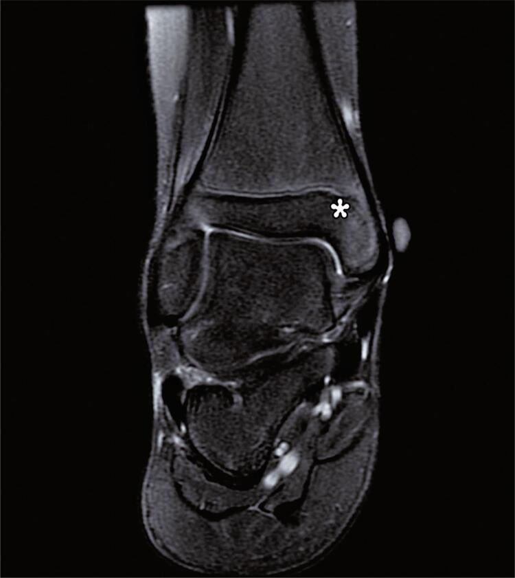 Acute ankle injuries: association between sprain severity and ancillary findings.