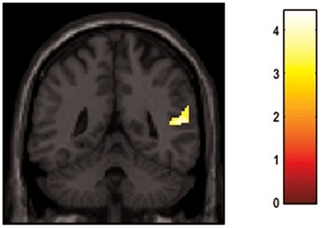 'I am afraid you will see the stain on my soul': Direct gaze neural processing in individuals with PTSD after moral injury recall.