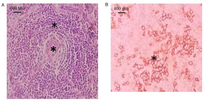 Castleman disease: Experience from a single institution.