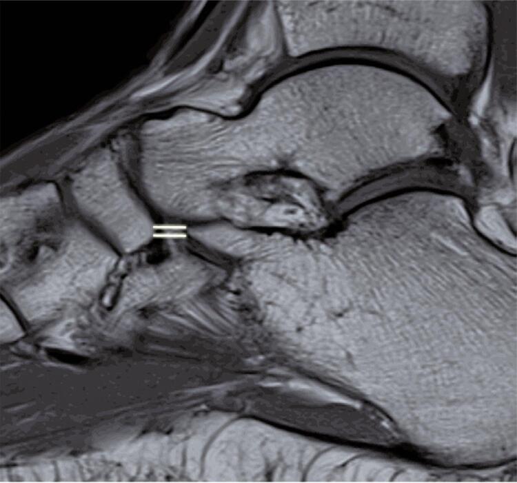 Acute ankle injuries: association between sprain severity and ancillary findings.