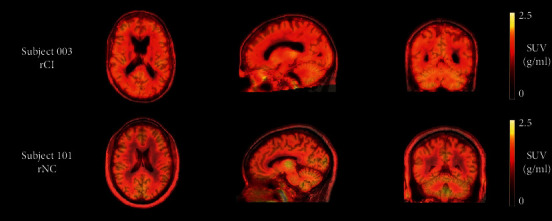 Cognitive Dysfunction in Patients Treated with Androgen Deprivation Therapy: A Multimodality Functional Imaging Study to Evaluate Neuroinflammation.