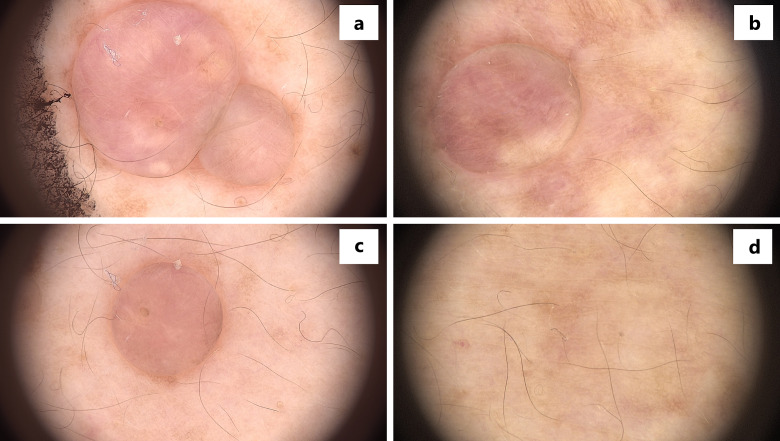 Treatment of Cutaneous Neurofibromas in Patients with Neurofibromatosis Type 1.