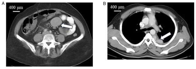 Castleman disease: Experience from a single institution.