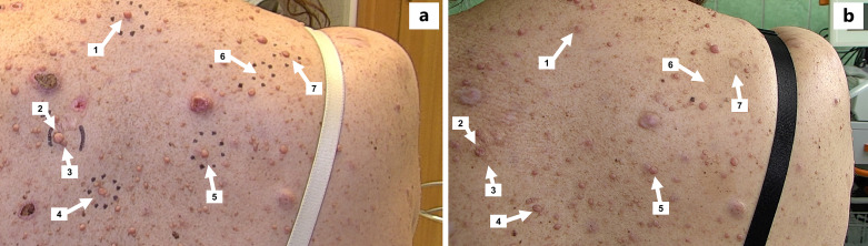 Treatment of Cutaneous Neurofibromas in Patients with Neurofibromatosis Type 1.