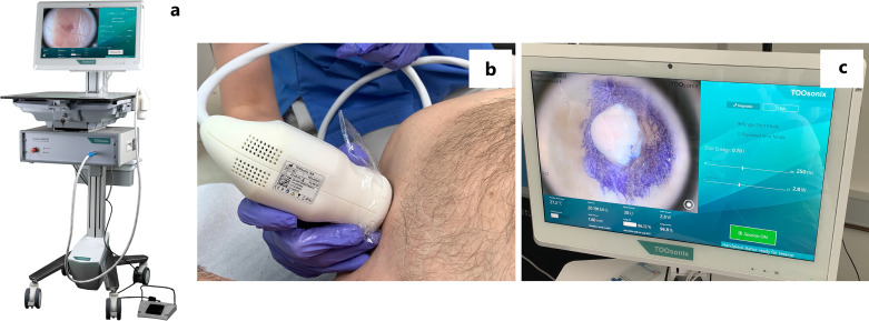 Treatment of Cutaneous Neurofibromas in Patients with Neurofibromatosis Type 1.