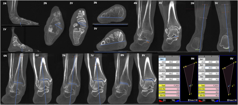 Decreased Peritalar Subluxation in Progressive Collapsing Foot Deformity with Ankle Valgus Tilting.