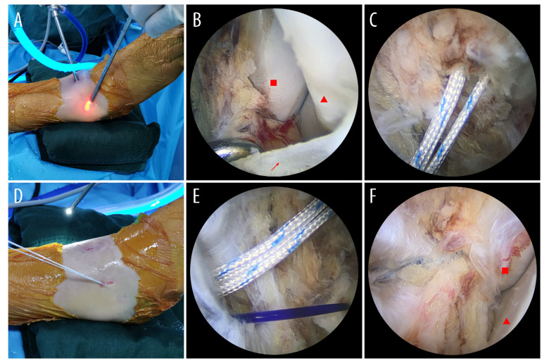 Comparative Evaluation of Metallic and Biodegradable Suture Anchors in Arthroscopic Repair of Anterior Talofibular Ligament Injury: A Short-term Study on Clinical and Functional Outcomes.