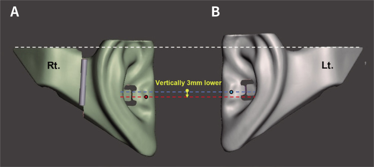 <i>In vitro</i> comparison of the accuracy of an occlusal plane transfer method between facebow and POP bow systems in asymmetric ear position.