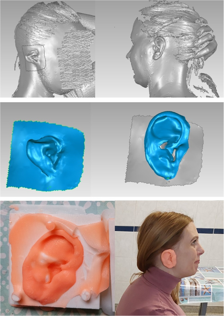 Cost-effective 3D scanning and printing technologies for outer ear reconstruction: current status.