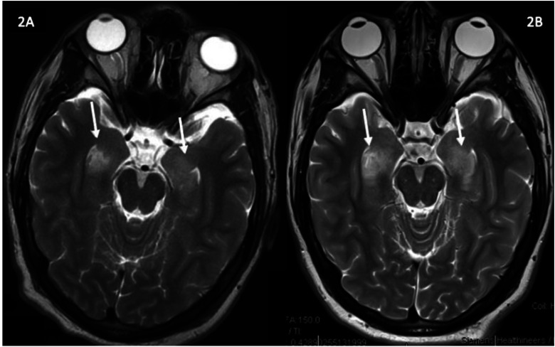 Limbic Encephalitis Associated with Human Herpesvirus-7 Infection in an Immunocompetent Adolescent.