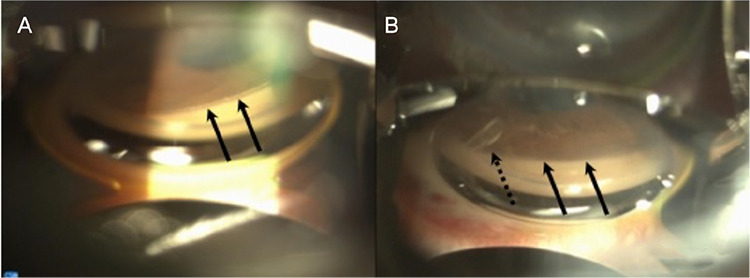 Combining Perfluorobutylpentane (F<sub>4</sub>H<sub>5</sub>) with Glaucoma Drainage Device Implantation for Silicone Oil-Induced Glaucoma: A Pilot Study.