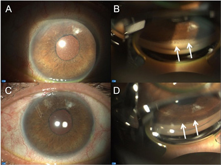 Combining Perfluorobutylpentane (F<sub>4</sub>H<sub>5</sub>) with Glaucoma Drainage Device Implantation for Silicone Oil-Induced Glaucoma: A Pilot Study.