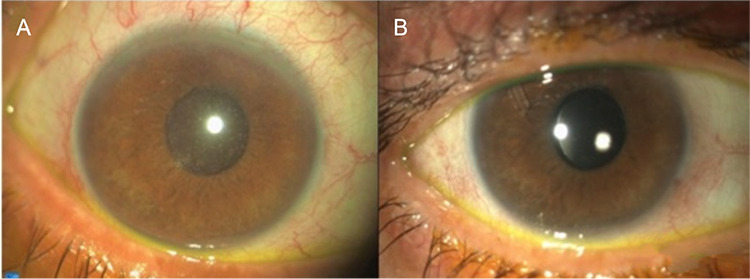 Combining Perfluorobutylpentane (F<sub>4</sub>H<sub>5</sub>) with Glaucoma Drainage Device Implantation for Silicone Oil-Induced Glaucoma: A Pilot Study.