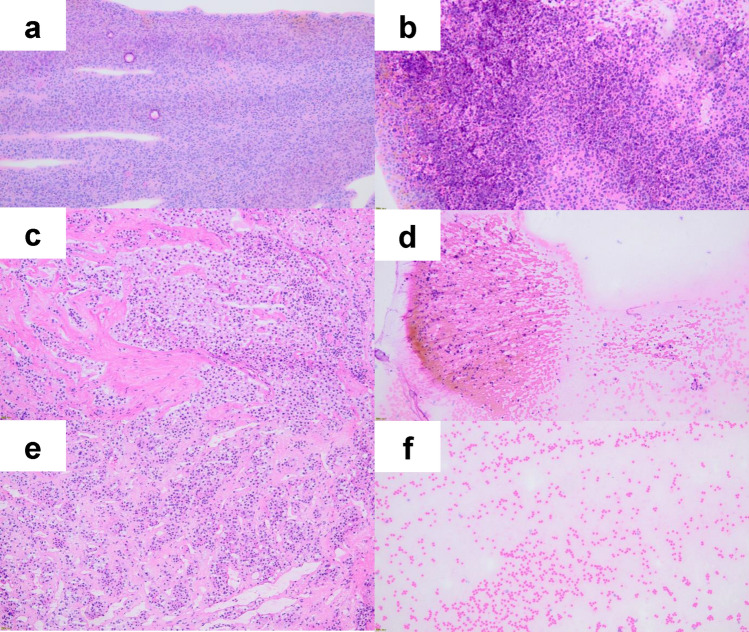 Touch imprint cytology is useful for the intraoperative pathological diagnosis of PitNETs' surgical margins.