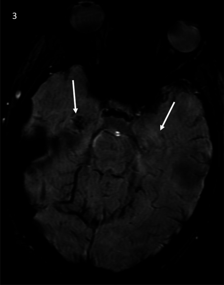 Limbic Encephalitis Associated with Human Herpesvirus-7 Infection in an Immunocompetent Adolescent.