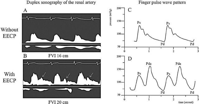 Enhanced external counterpulsation, focusing on its effect on kidney function, and utilization in patients with kidney diseases: a systematic review.