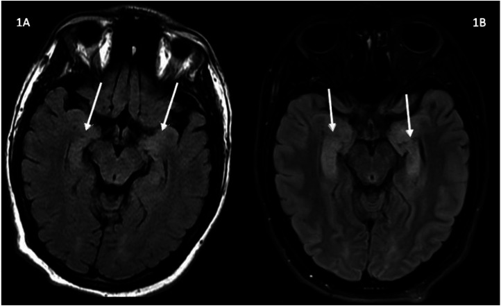 Limbic Encephalitis Associated with Human Herpesvirus-7 Infection in an Immunocompetent Adolescent.