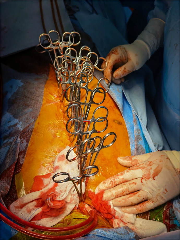 Hypothermic Circulatory Arrest in Median Sternotomy Hemorrhage During Redo Aortic Surgery.