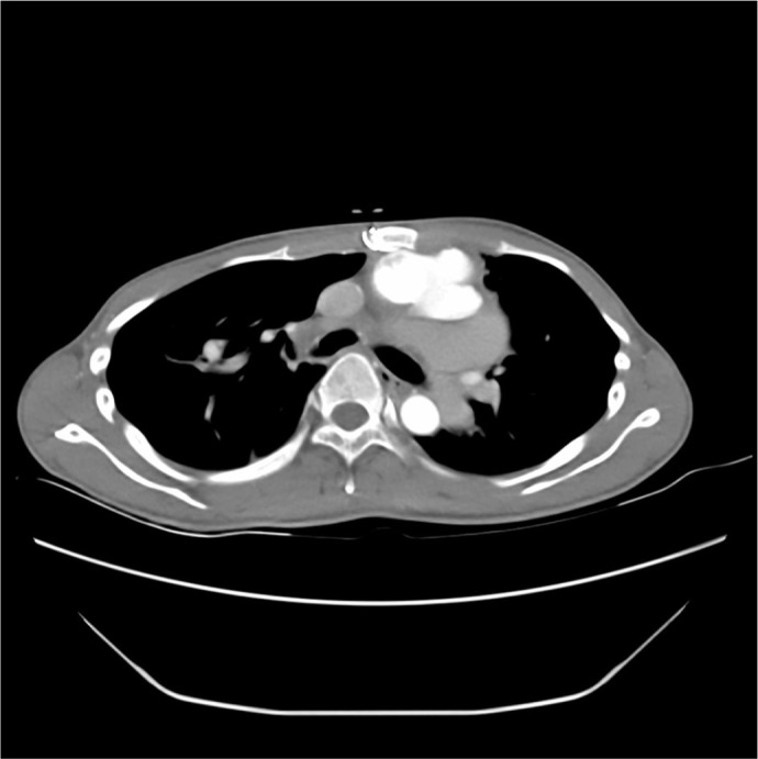 Hypothermic Circulatory Arrest in Median Sternotomy Hemorrhage During Redo Aortic Surgery.