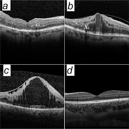 Detection and Classification of Diabetic Macular Edema with a Desktop-Based Code-Free Machine Learning Tool.