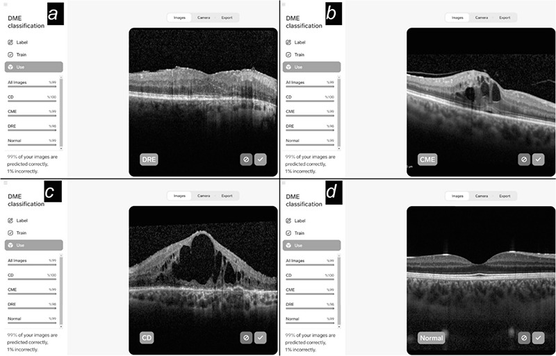 Detection and Classification of Diabetic Macular Edema with a Desktop-Based Code-Free Machine Learning Tool.