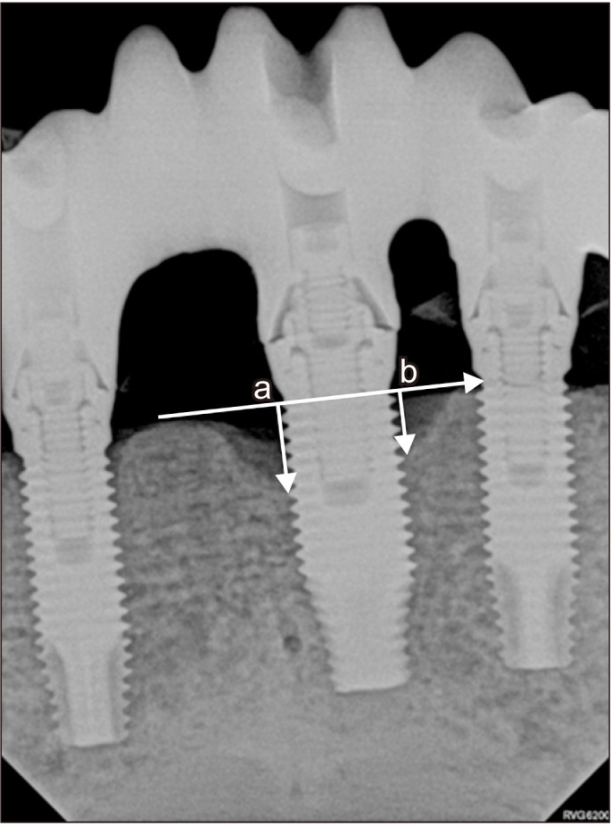 Tilted implants for implant-supported fixed hybrid prostheses: retrospective review.