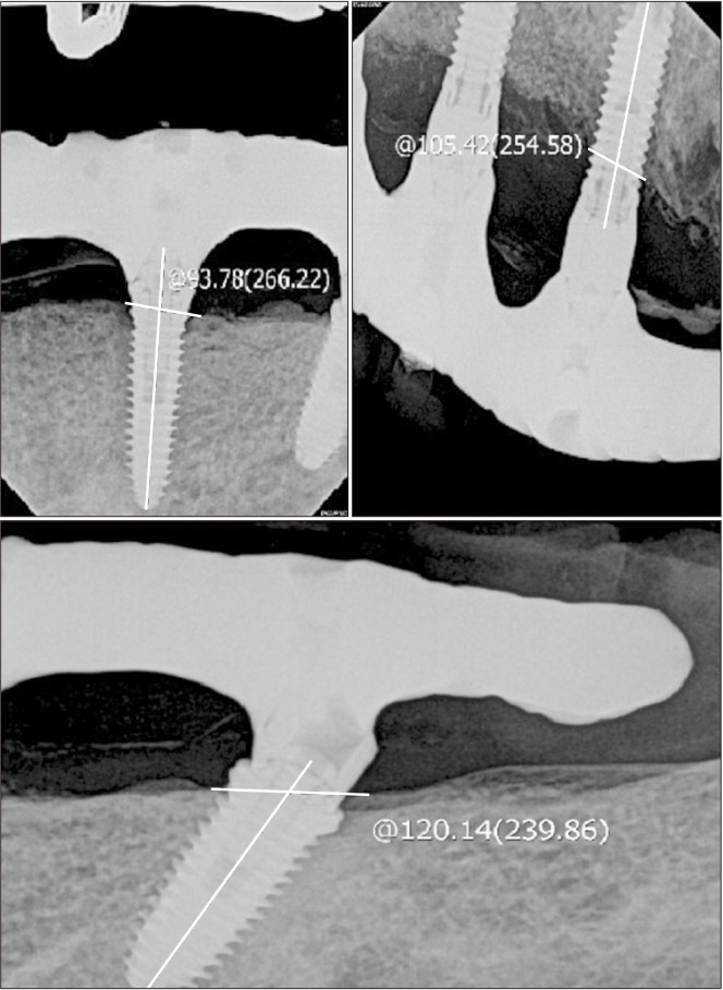 Tilted implants for implant-supported fixed hybrid prostheses: retrospective review.