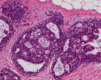 Ductal Carcinoma Arising in a Squamous Epithelial Inclusion Cyst within an Axillary Lymph Node: A Challenging Nodal Metastasis.