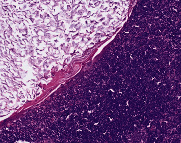 Ductal Carcinoma Arising in a Squamous Epithelial Inclusion Cyst within an Axillary Lymph Node: A Challenging Nodal Metastasis.