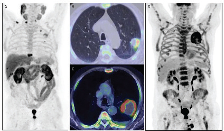 Incidental Detection of Sarcomatoid Lung Cancer by [<sup>18</sup>F] Choline Positron Emission Tomography/Computed Tomography.