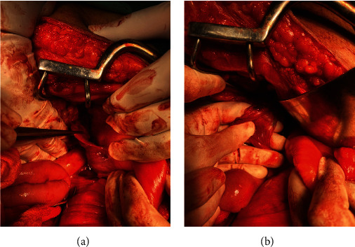 Unusual Location of Residual Mass in an Uncorrected Undescended Testis with Germ Cell Tumor.