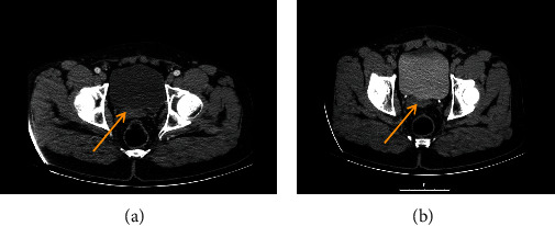 Unusual Location of Residual Mass in an Uncorrected Undescended Testis with Germ Cell Tumor.