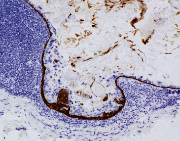 Ductal Carcinoma Arising in a Squamous Epithelial Inclusion Cyst within an Axillary Lymph Node: A Challenging Nodal Metastasis.