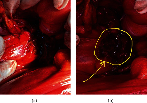 Unusual Location of Residual Mass in an Uncorrected Undescended Testis with Germ Cell Tumor.