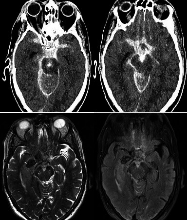 Oculomotor palsy and drowsiness due to post-thrombectomy subarachnoid haemorrhage falsely suggesting transtentorial herniation.