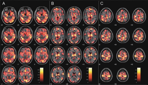 Structural brain changes in emotion recognition across the adult lifespan.