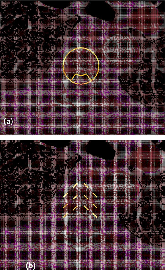 Monte Carlo Dosimetric Study of Percutaneous Vertebroplasty and Brachytherapy for the Treatment of Spinal Metastases.