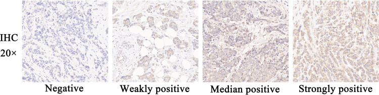 PDL1-Based Nomogram May Be of Potential Clinical Utility for Predicting Survival Outcome in Stage III Breast Cancer.