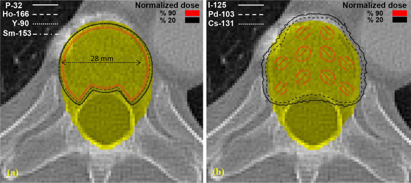 Monte Carlo Dosimetric Study of Percutaneous Vertebroplasty and Brachytherapy for the Treatment of Spinal Metastases.