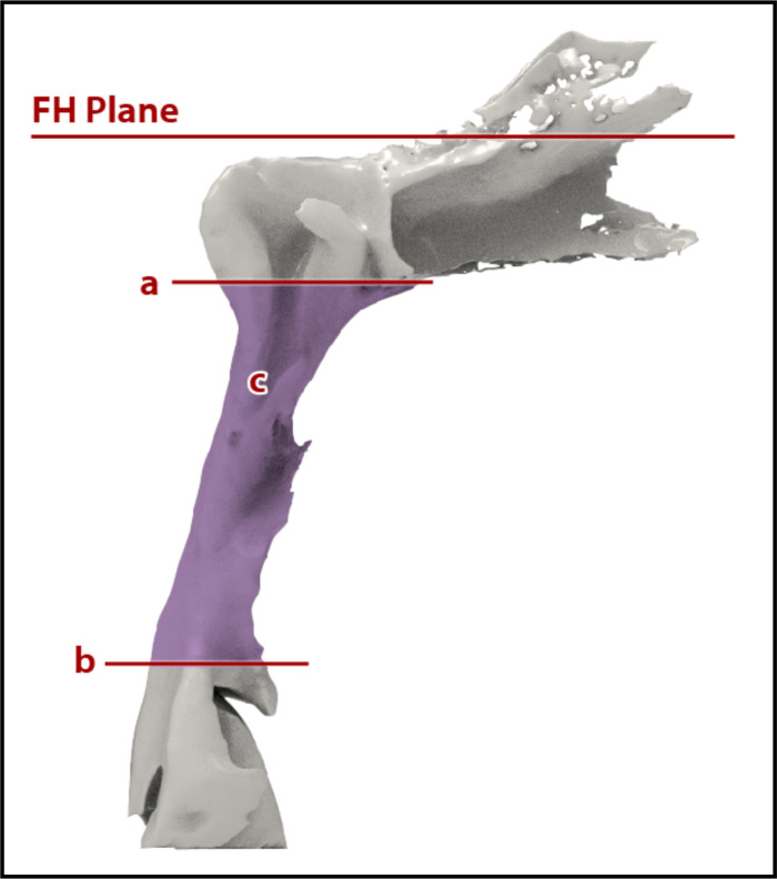 Three-Dimensional Analysis of the Pharyngeal Airway According to Craniofacial Morphology.