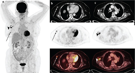 Investigation of Clinical Histopathologic Features and Metabolic Parameters of <sup>18</sup>F-FDG PET/CT in Invasive Breast Carcinoma with a Micropapillary Component.