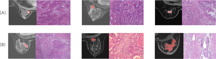 A Comprehensive Model Based on Dynamic Contrast-Enhanced Magnetic Resonance Imaging Can Better Predict the Preoperative Histological Grade of Breast Cancer Than a Radiomics Model.