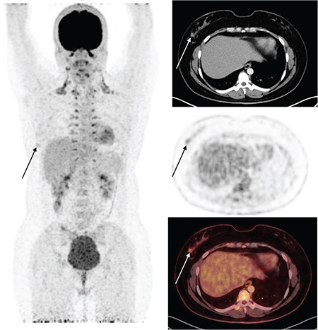 Investigation of Clinical Histopathologic Features and Metabolic Parameters of <sup>18</sup>F-FDG PET/CT in Invasive Breast Carcinoma with a Micropapillary Component.