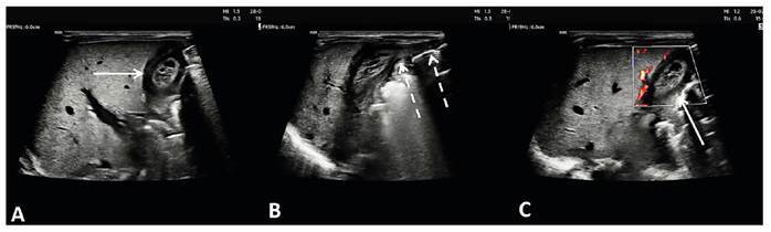 Thrombosed umbilical vein varix in newborn with congenital syphilis.