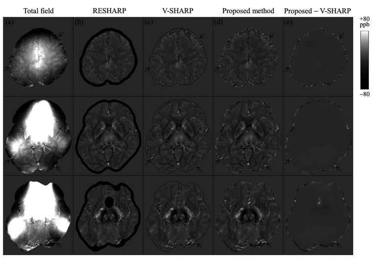 Region Expansion of Background Field Removal with Local Spherical Harmonics Approximation for Whole-brain Quantitative Susceptibility Mapping.